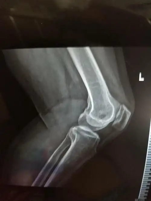 膝盖骨刺,骨质增生