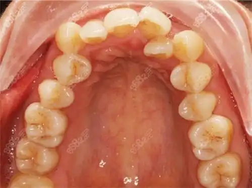 杭州格莱美口腔隐形矫正攻略,想说整完牙变化大,价格还不贵,牙齿矫正