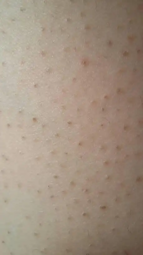 这是我腿上的皮肤应该怎么治?