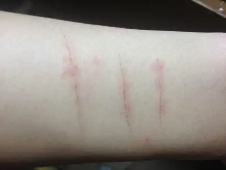 心情不好的时候喜欢拿刀子在胳膊上划舒院长让你小心抑郁自伤