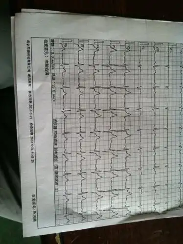 心电图 检测:电轴右偏,严重吗?还有舒张压59,收缩压110,脉搏73!请专家