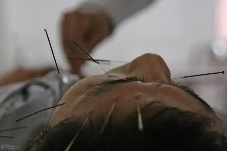 面瘫针灸多久面瘫做针灸的最佳时间