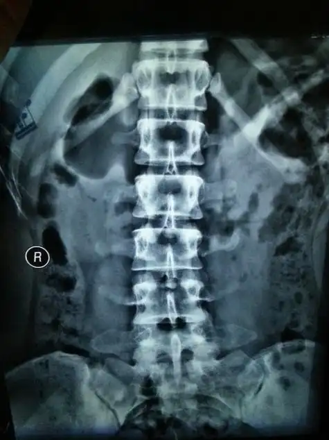 腰椎骨折如何治疗?