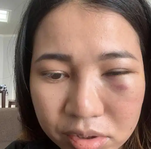 脸被打肿了怎么办才能消肿,脸被打肿一般几天恢复