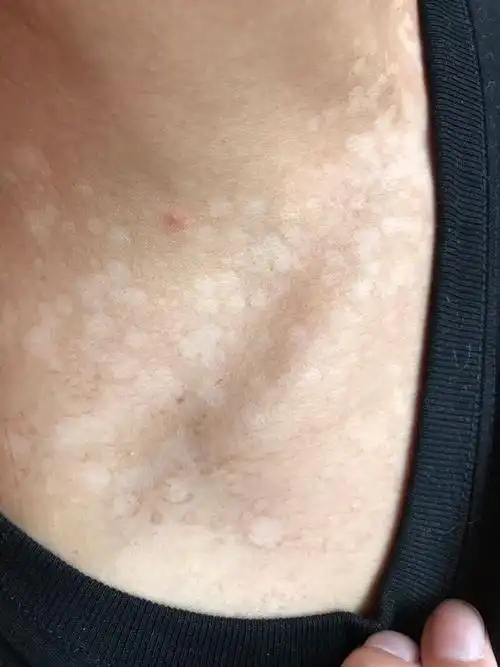 夏季常见皮肤病花斑癣