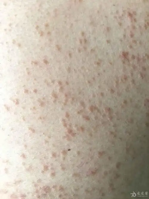 69 ★临床第三区 69 皮肤及性传播疾病讨论版 69 胸腹部丘疹8年