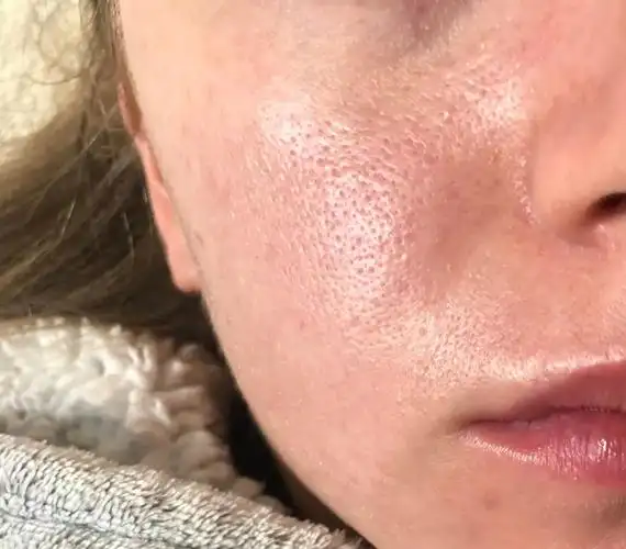 毛孔粗大的原因及解决方法,用哪款水光解决毛孔粗大?