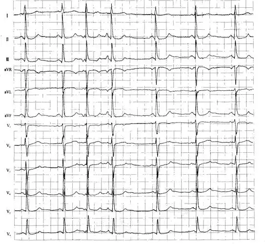 9-4 先后发生的交界性早搏及房性早搏-精编心电图诊断-医学