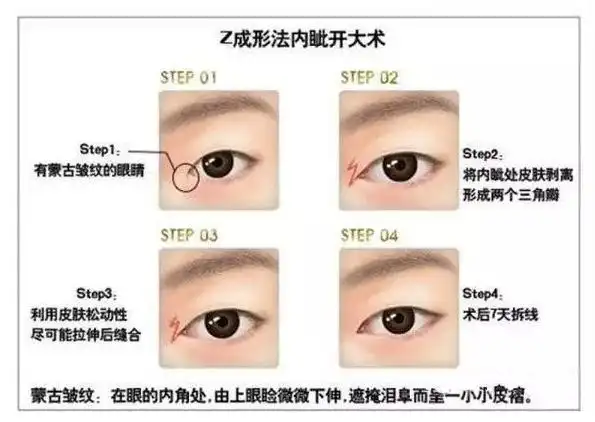 生活中开内眼角与外眼角的区别及手术详解