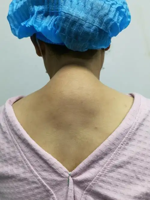 好大的富贵包,一次消除即刻展现#富贵包  #肩颈大