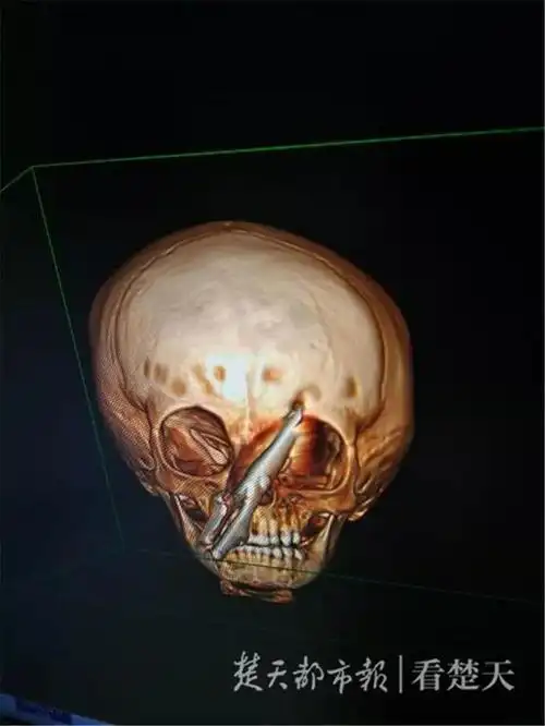 剪刀突然插进2岁男孩头颅!当时妈妈正在…医生也惊呆了