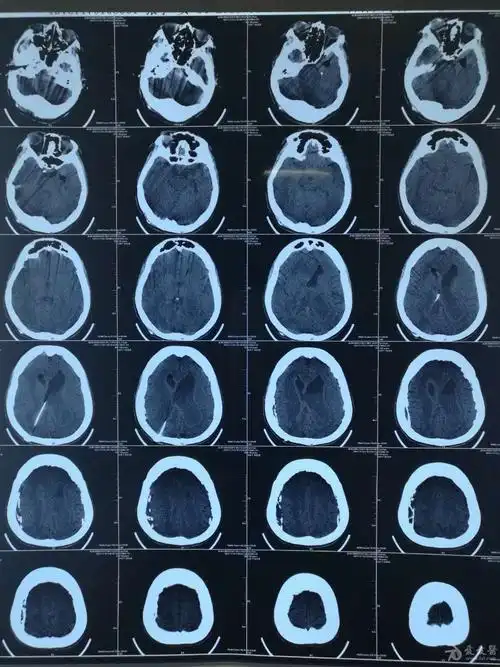 罕见脑积水病例