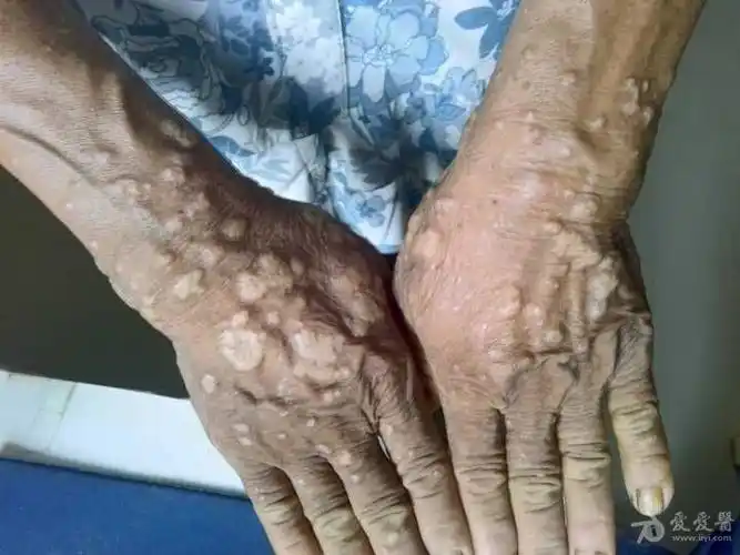 看图诊断寻常疣