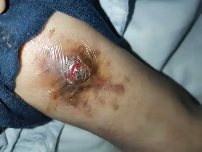 左胫腓骨骨折髓内钉内固定术后感染治疗分享