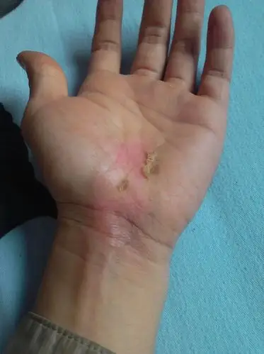 4 2008-08-12 脸部一度烧伤肤色会恢复原来的肤色吗 3 2009-07-17