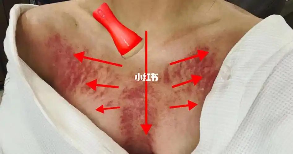 胸腺刮痧,缓解嗓子不适的各种问题