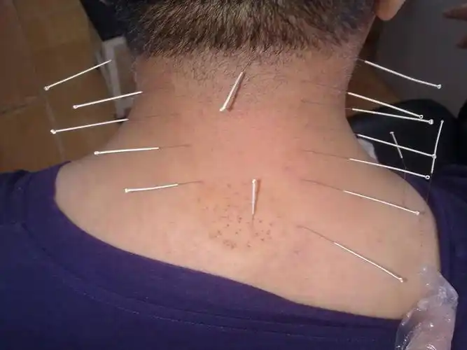 针灸治疗颈椎病以局部取穴为主 ,随证( 症 )循经远近配穴 ,针刺颈部