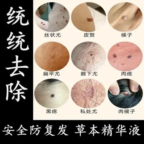 丝状疣去除膏日本