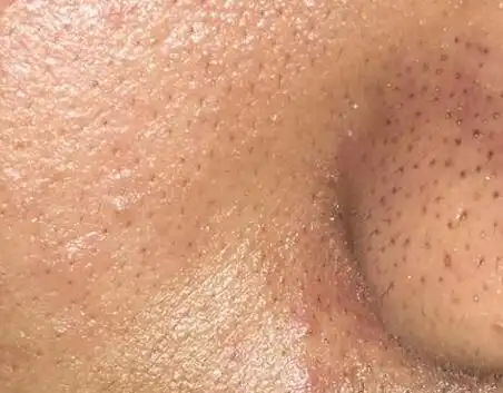 为何皮肤出油会毛孔粗大如何改善毛孔粗大问题