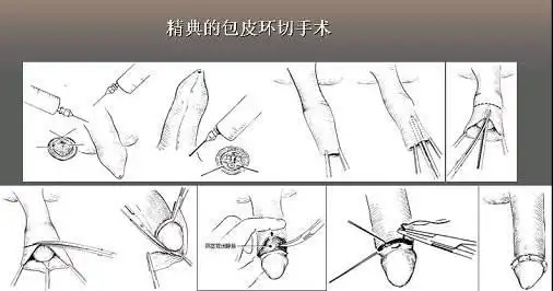 >>正文    包皮环切术是一种完全符合生殖卫生及疾病预防,保健的手术
