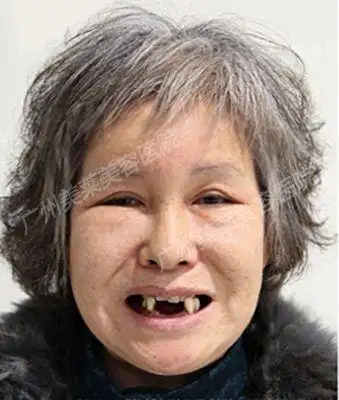 牙齿脱落用种植牙修复行吗