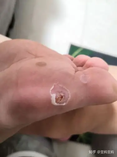 跖疣治疗过程分享