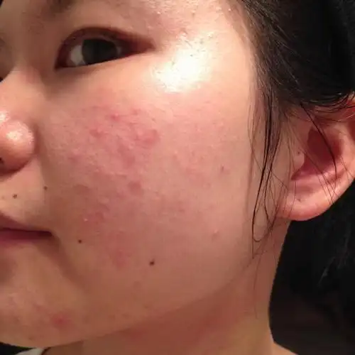 摸上去一大片的疙瘩,是过敏性皮肤不敢尝试各种护肤品,太热太冷脸都会