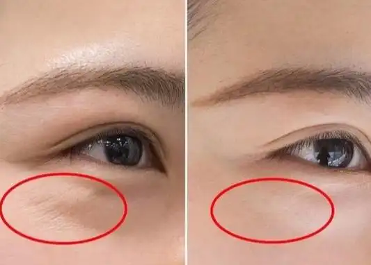 鱼尾纹和笑纹图片对比笑纹和鱼尾纹怎么去除