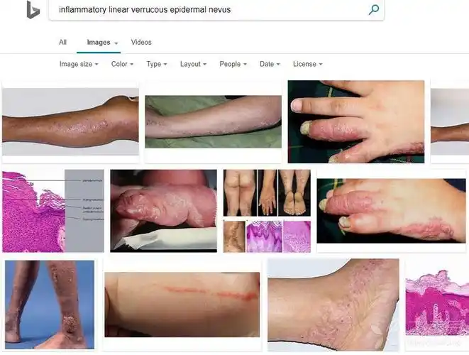 原来小面积线状丘疹,没出天疱疮以前就有