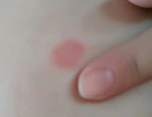 一侧乳房上有红斑几天前有脱皮,现在不痛不痒,胸口其他地方有几个小