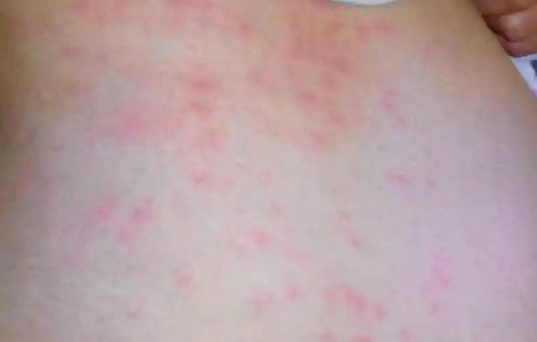 身上起冷风疙瘩怎么办 身上有冷风疙瘩是什么症状