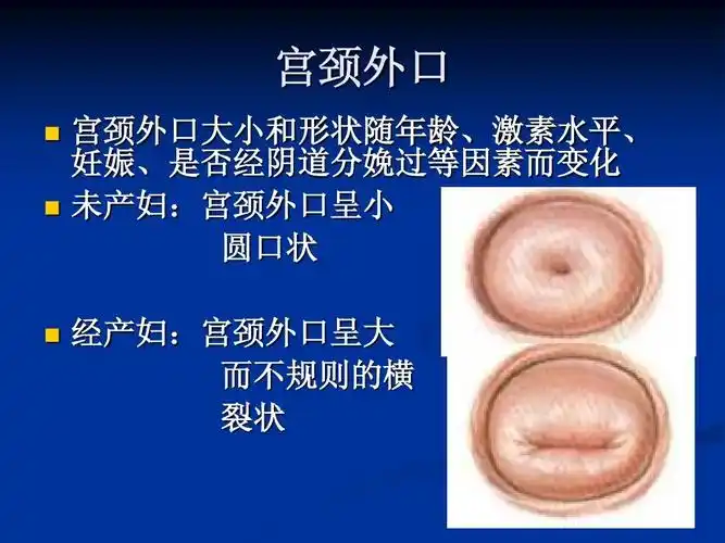 宫颈外口    宫颈外口大小和形状随年龄,激素水平, 妊娠,是否经阴道