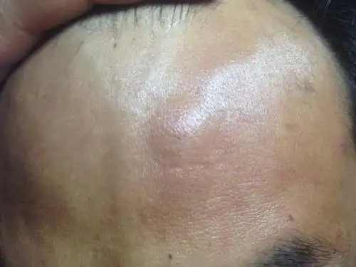 额头几年前长一小瘤摸不痛最近好像长的太快