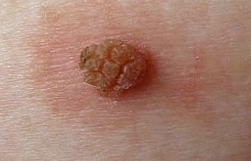 丝状疣反复发作怎么办_疣_介绍_治疗方式_日常注意事项 - 好大夫在线