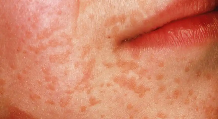 长时间无法消散,一定要重视起来,可能就是由于hpv感染而出现的皮肤疣