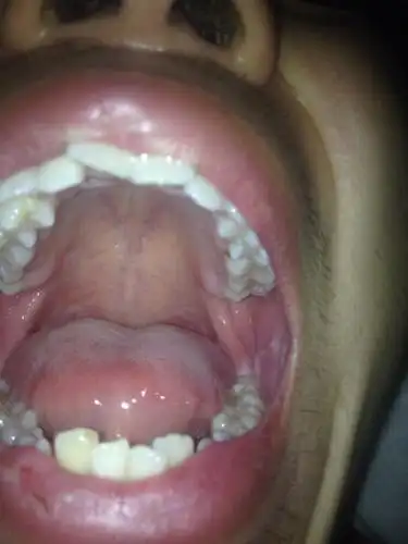 是艾滋病口腔症状吗,急求医生看看