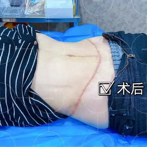 大名鼎鼎的"肚子缩小手术_圈子-新氧美容整形