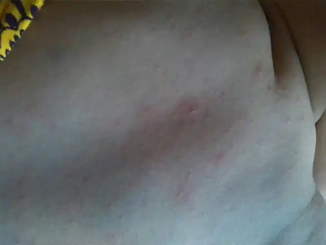 问:八个月宝宝9号出的幼儿急疹,四天后退下了.