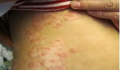 牛皮癣症状初期图片_银屑病求医网