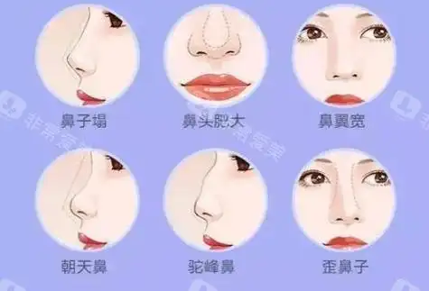 各种鼻型问题示意图