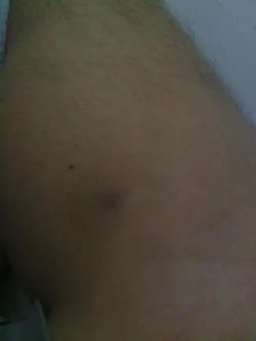 问:18年前腿上长了个小疙瘩,很小,碰到非常疼,平