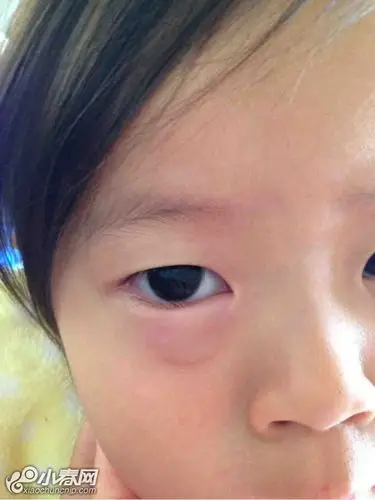 急问,闺女眼睑上起了水泡 - 婚姻育儿 - 小春论坛 - 小春