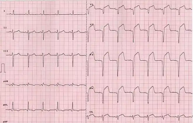 16种临床最常见异常心电图的特点看完后想不会都难建议收藏