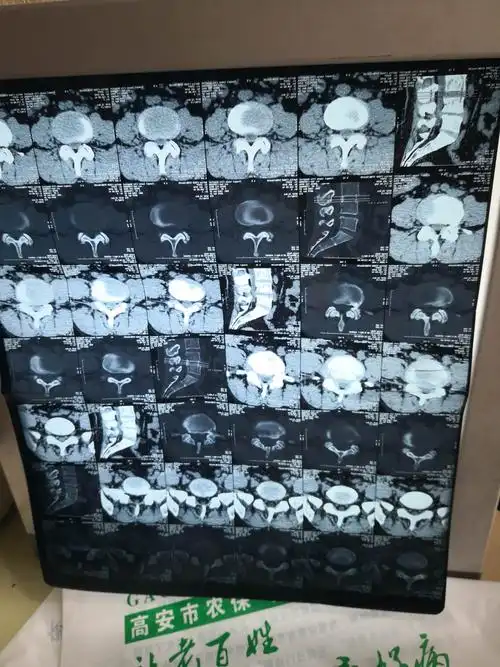 腰椎ct显示l4-5椎间盘突出,腰椎管狭窄