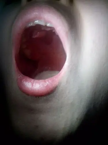 口腔上颚长了个泡,导致牙也跟着疼