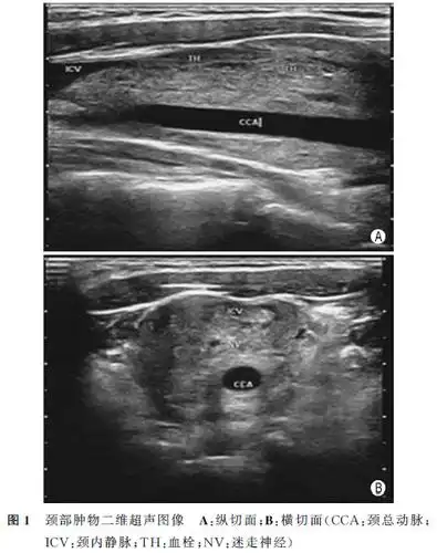 超声检查示:左颈动脉鞘内(甲状腺水平)见一低回声肿物(图1a),大小约5.