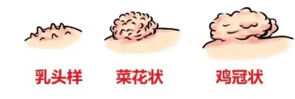 一旦感染,不管是外阴,阴道,宫颈和肛周附近会出现一些表面凹凸不平的