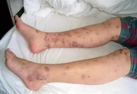 男性霉菌性龟头炎的表现