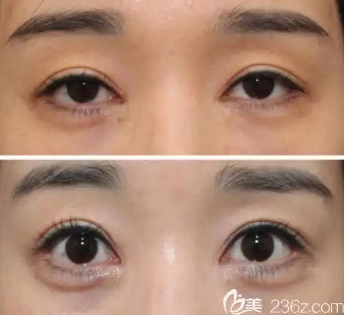 双眼皮的疤痕如何修复?