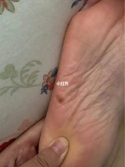 这种脚底痣需要切除么?颜色很淡不突出但很大!边缘不整齐!哺乳期